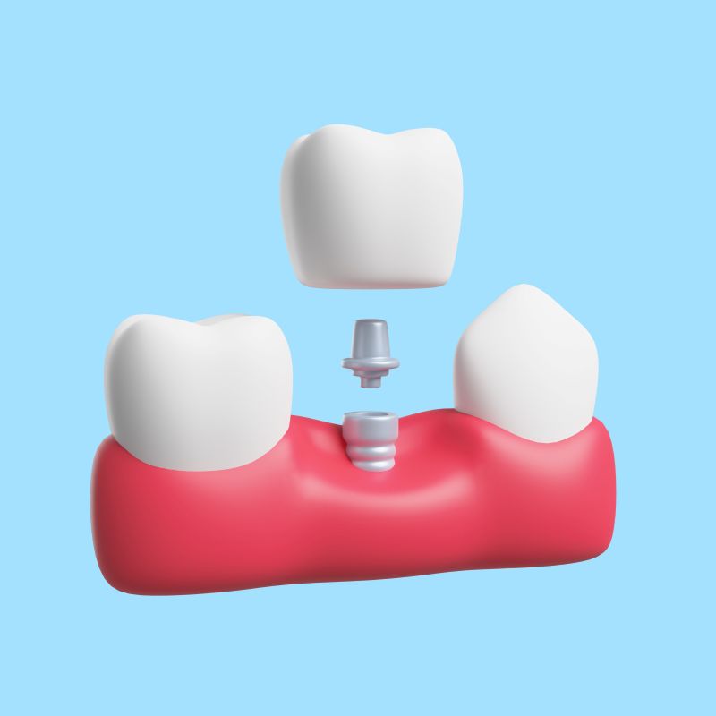 dental implant