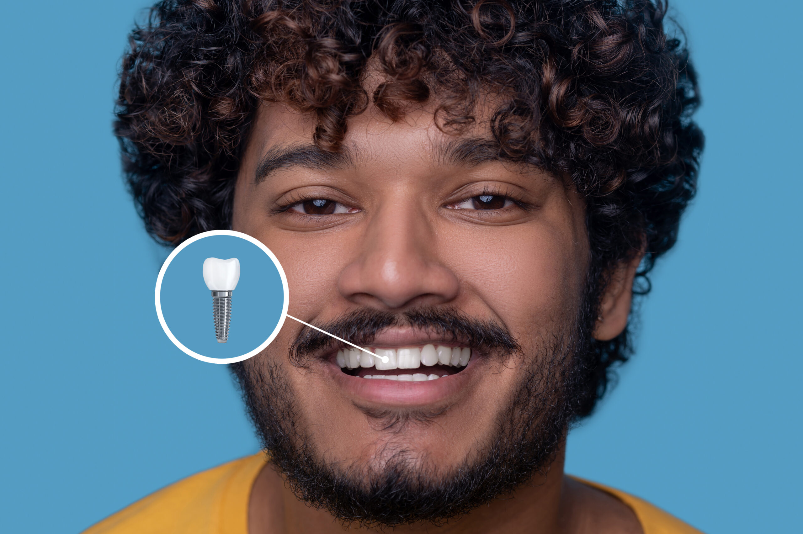 Dental Implant Cost in Delhi